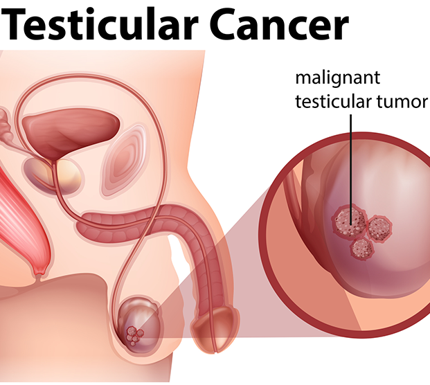 Anatomical illustration of testicular cancer