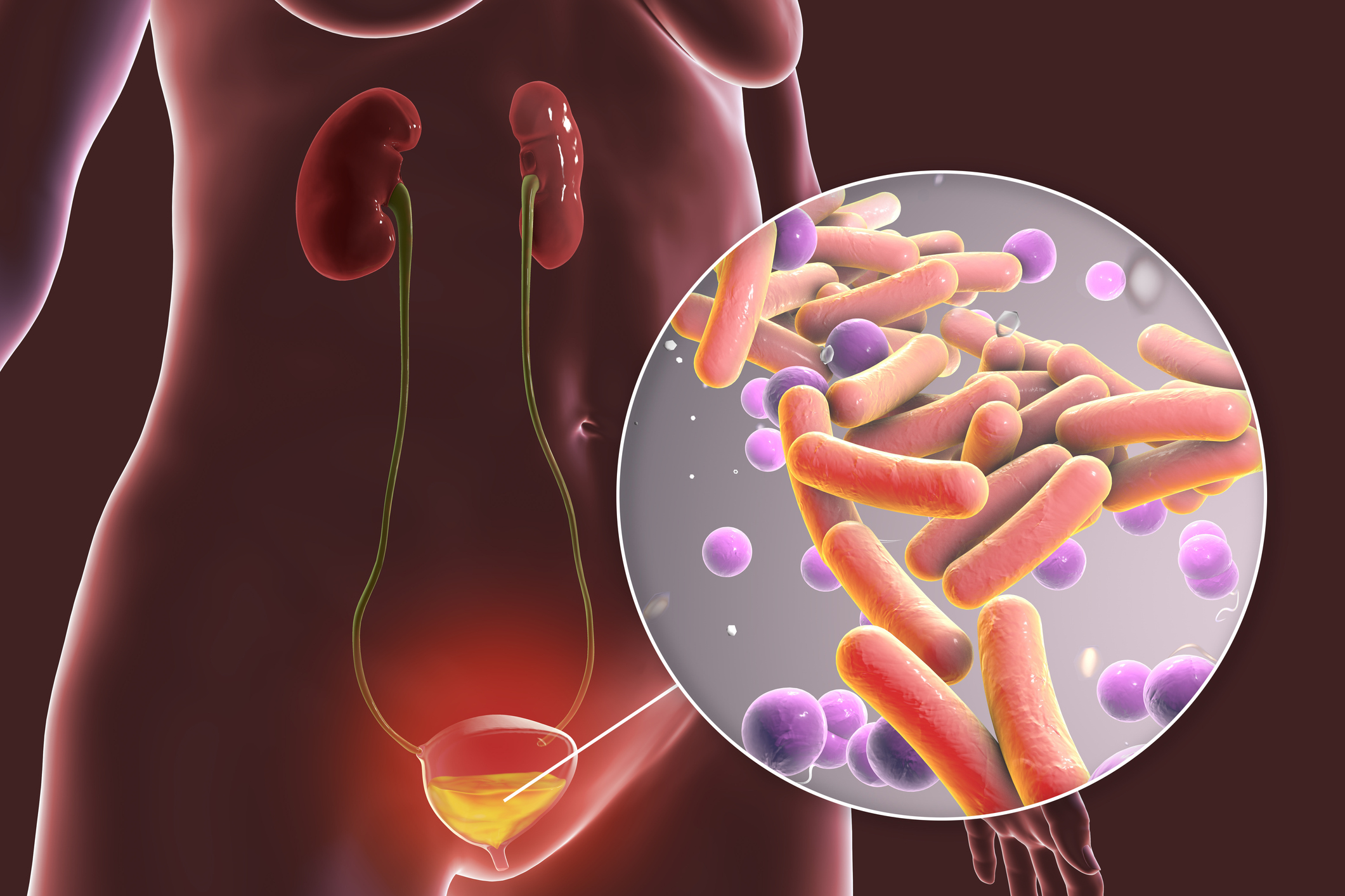 Digital illustration of a urinary tract infection