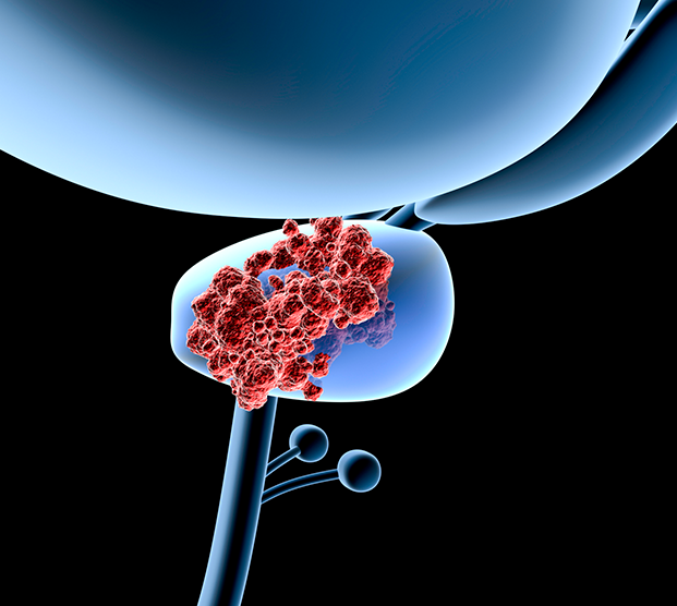 Digital illustration of prostate cancer treated by cryoablation