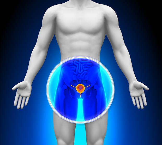 Digital illustration of prostate treated during robot assisted prostatectomy