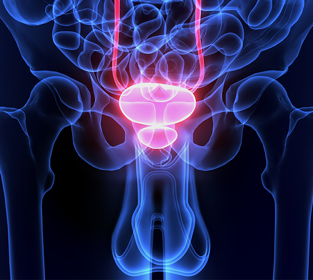 Digital illustration of prostate treated with HIFU