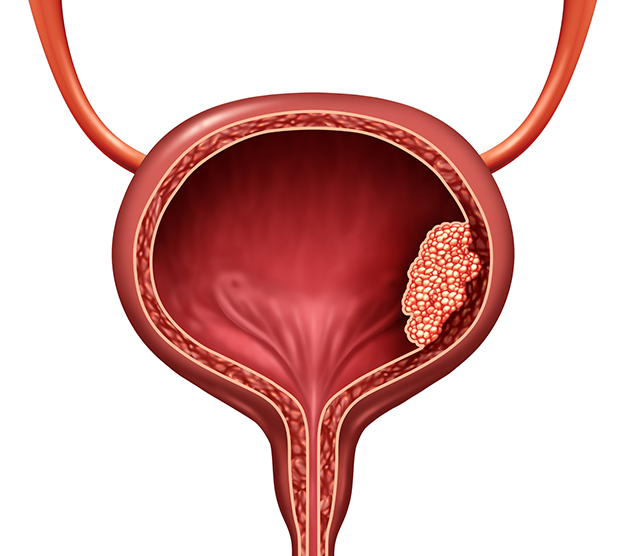Illustration of bladder cancer