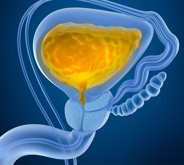 Illustration of bladder removed during cystectomy
