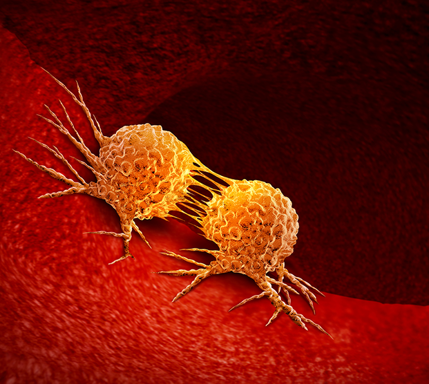 Illustration of cancer treated by RPLND