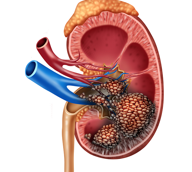 Illustration of kidney with cancer that needs cryoablation treatment