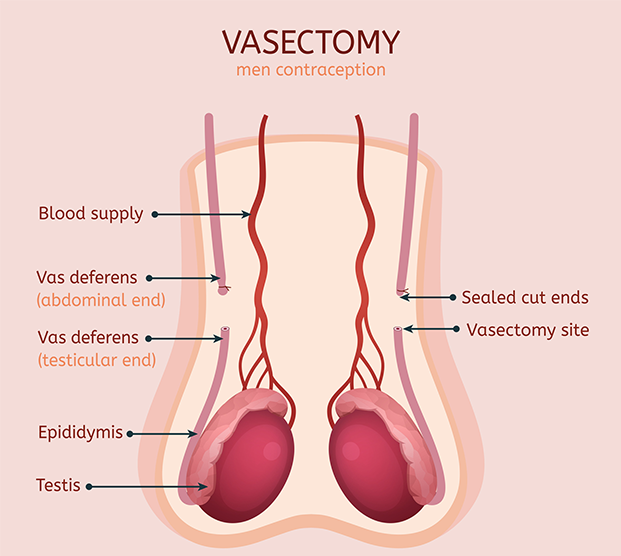 Medical illustration of a vasectomy