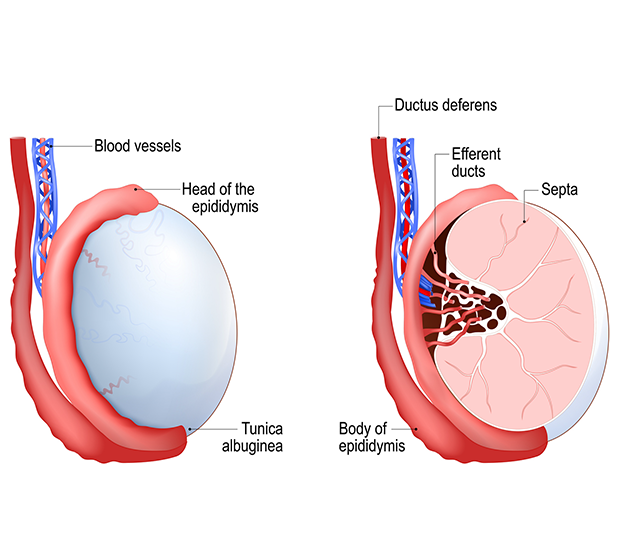 Medical illustration of testicle involved in varicocele