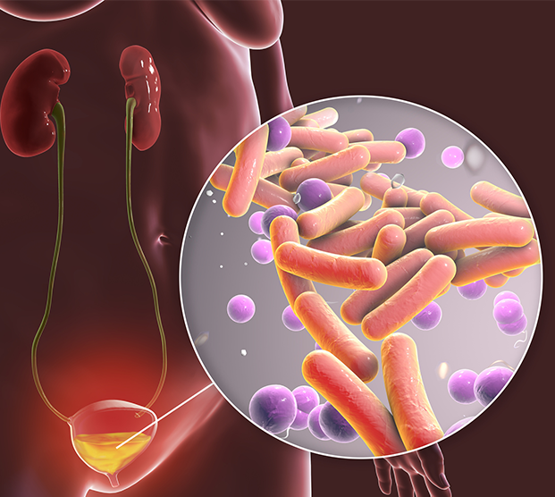 Digital illustration of a urinary tract infection