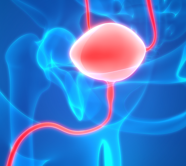 Illustration of malfunctioning bladder