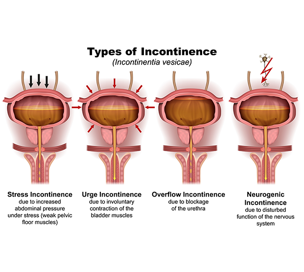 Illustration of various types of urinary incontinence