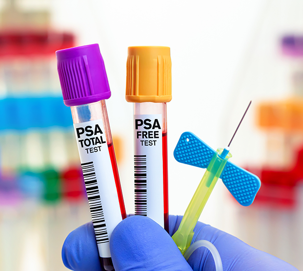 Lab worker holding vials of PSA