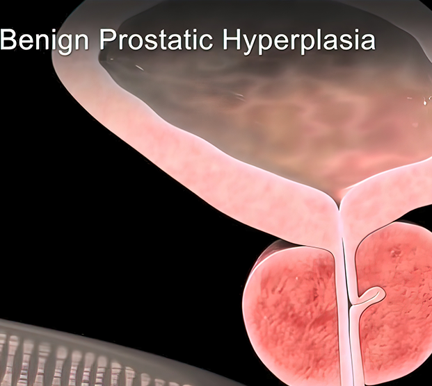 Medical illustration of benign prostatic hyperplasia