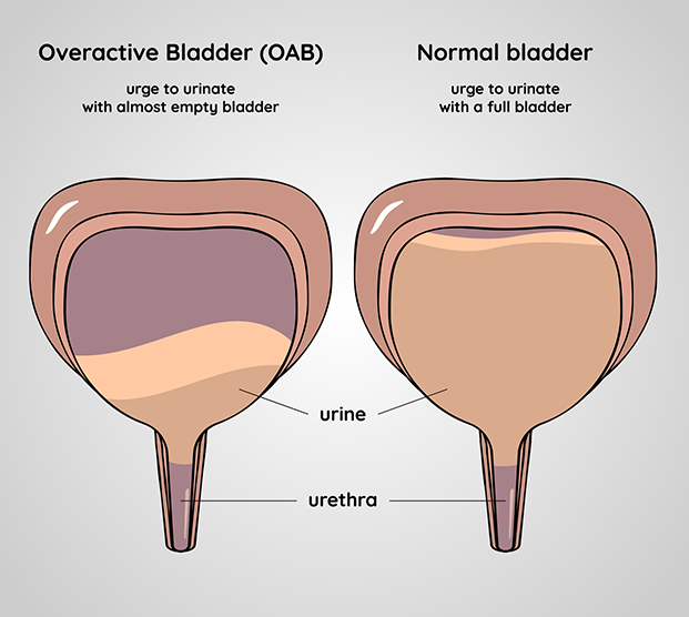 illustration of an overactive bladder